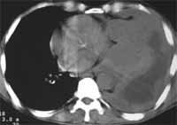 Adenocarcinoma de hemitórax izquierdo Adenocarcinoma de hemitórax izquierdo