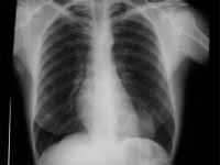 Masa pulmonar basal izquierda Masa pulmonar basal izquierda