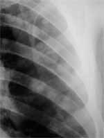 Enfermedad pulmonar metastásica. Enfermedad pulmonar metastásica.