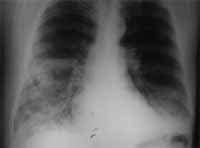 Rx tórax con infiltrados en base de hemitórax derecho