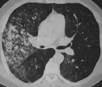 TAC de tórax con infiltrados alveolares TAC de tórax con infiltrados alveolares