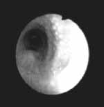 Histoplasmosis diseminada