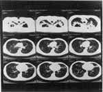 Tac  estudio del esputo, escanografía de alta resolución (TACAR) Tac  estudio del esputo, escanografía de alta resolución (TACAR)