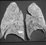 Pulmones aumentados de volumen