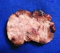 Fig. 3 A. Lóbulo superior derecho.