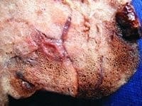 Fig. 3B. Acercamiento que muestra la hiperdistensión de los alvéolos. Fig. 3B. Acercamiento que muestra la hiperdistensión de los alvéolos.