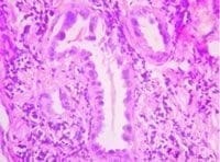 Fig. 1 y 2. En 1 (H&E - 100x), se identifican espacios alveolares con intersticio ensanchado Fig. 1 y 2. En 1 (H&E - 100x), se identifican espacios alveolares con intersticio ensanchado