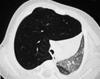 Fig. 2 A, B, C y D. TCAR Sobreinsuflación del lóbulo superior derecho con hipovascularidad Fig. 2 A, B, C y D. TCAR Sobreinsuflación del lóbulo superior derecho con hipovascularidad1