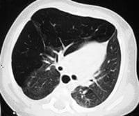 Fig. 2 A, B, C y D. TCAR Sobreinsuflación del lóbulo superior derecho con hipovascularidad2