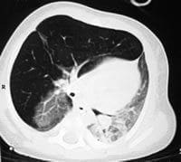 Fig. 2 A, B, C y D. TCAR Sobreinsuflación del lóbulo superior derecho con hipovascularidad Fig. 2 A, B, C y D. TCAR Sobreinsuflación del lóbulo superior derecho con hipovascularidad2