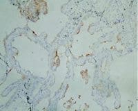 Fig. 3 y 4. En 4 (100x - ACE), la marcación con antígeno carcinoembrionario