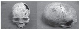 Craneos trepanados en Colombia Craneos trepanados en Colombia