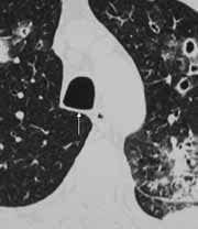 TAC pulmón derecho en el receso supraácigos.