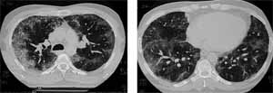 Tomografía de tírax de alta resolución que muestra lesión intra alveolar Tomografía de tírax de alta resolución que muestra lesión intra alveolar