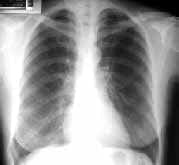 Rx de tórax opacidades reticulares finas Rx de tórax opacidades reticulares finas