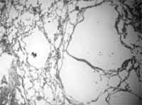 Biopsia pulmonar HE 10X Biopsia pulmonar HE 10X