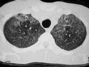 TACAR Con vidrio esmerilado difuso e infiltrados alveolares TACAR Con vidrio esmerilado difuso e infiltrados alveolares