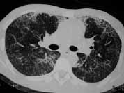 TACAR Con vidrio esmerilado difuso e infiltrados alveolares TACAR Con vidrio esmerilado difuso e infiltrados alveolares