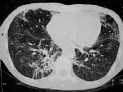 TACAR Con vidrio esmerilado difuso e infiltrados alveolares TACAR Con vidrio esmerilado difuso e infiltrados alveolares