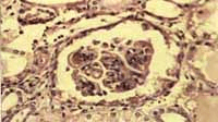 Microfotografía de otro glomérulo mostrando engrosamiento Microfotografía de otro glomérulo mostrando engrosamiento