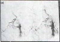 Arteriografía bronquial Arteriografía bronquial