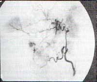 arteriografía bronquial derecha arteriografía bronquial derecha
