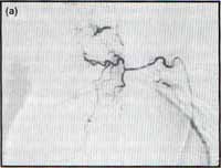 Arteriografía bronquial derecha, muestra dilatación y tortuosidad de las ramas bronquiales Arteriografía bronquial derecha, muestra dilatación y tortuosidad de las ramas bronquiales
