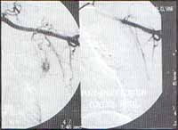 Hemoptisis por aspergiloma Hemoptisis por aspergiloma