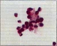  eosinófilos en la fase aguda