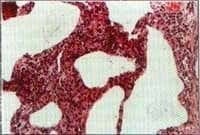  Biopsia pulmonar.con Engrosasmiento septal