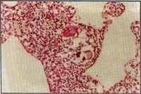 Bopsia pulmonar con  Presencia de granuloma
