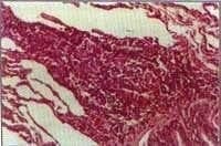  Bopsia pulmonar con Presencia de Pseudogranuloma