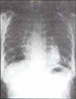 pérdida de v olumen pulmonar