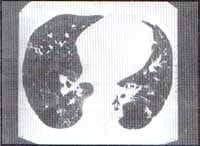 Áreas de aumento de la densidad del parénquima pulmonar