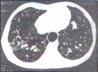 Áreas de patrón en «Vidrio esmerilado