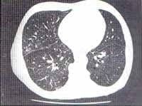 Presencia de opacidades nodulares centrilobulares pequeñas