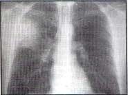 lóbulo superior derecho