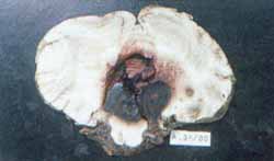 Fotomicrografía de la malformación vascular intraparenquimatosa del cerebelo Fotomicrografía de la malformación vascular intraparenquimatosa del cerebelo