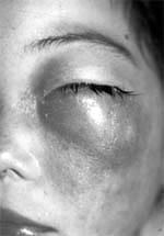 Edema palpebral Edema palpebral