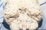 Aspecto lechoso de la meninge sobre tronco Aspecto lechoso de la meninge sobre tronco