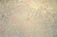 Lesión granulomatosa miliar  Lesión granulomatosa miliar