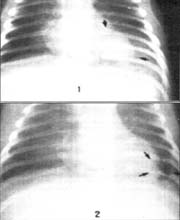 Neumonía del lóbulo inferior izquierdo por S. aureus Neumonía del lóbulo inferior izquierdo por S. aureus