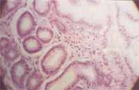 Biopsia de estómago,edema de lámina propia Biopsia de estómago,edema de lámina propia