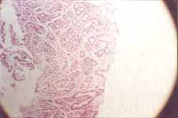 Biopsia de cuerpo gástrico, incremento de glándulas y edema de lámina propia Biopsia de cuerpo gástrico, incremento de glándulas y edema de lámina propia