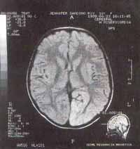 Síndrome de la Plaqueta Pegajosa