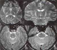 Aumento de la intensidad de la sustancia blanca Aumento de la intensidad de la sustancia blanca