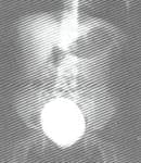 Después de la implantación con macroplástico