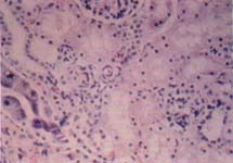 Citomegalovirus a nivel de estómago