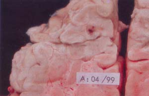Lesiones isquémicas del cerebro
