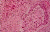 imagen característica del daño alveolar difuso imagen característica del daño alveolar difuso